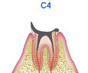 歯髄の虫歯（C3）